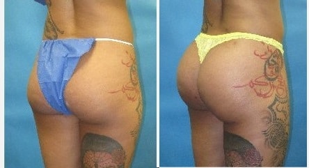 Prix augmentation fesses en Tunisie
