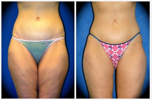 lifting cuisses Maroc