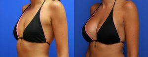 Lipofilling pecho precio Marruecos