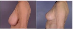 Reduction mammaire Maroc