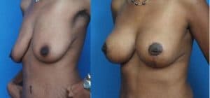 prix lifting seins