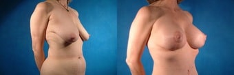 lifting seins Maroc