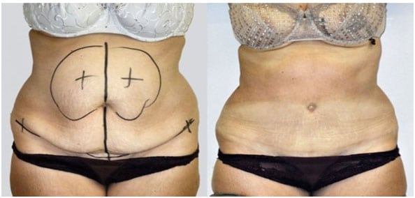abdominoplastia antes y después