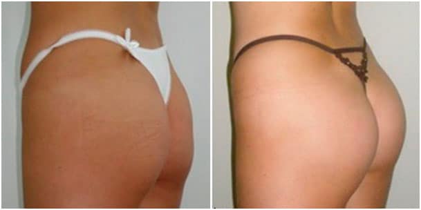 aumento de glúteos antes y después