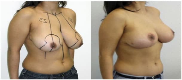 lifting mamario antes y después