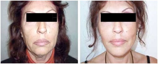 lifting facial antes y después