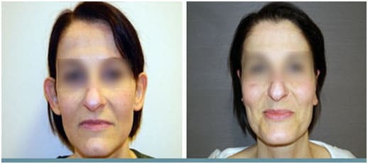 otoplastia antes y después