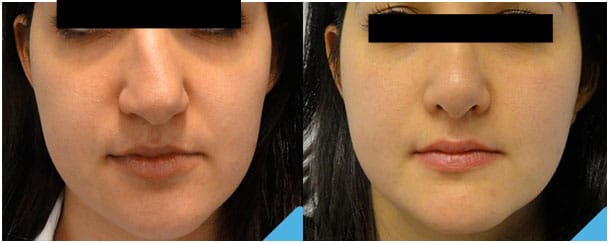 rinoplastia antes y después