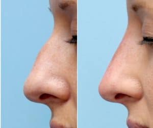 Rinoplastia médica precio Marruecos Rinoplastia médica precio Marruecos