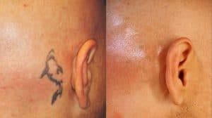 Eliminación de tatuajes con láser Marruecos