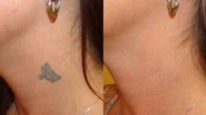 Detatouage laser Maroc