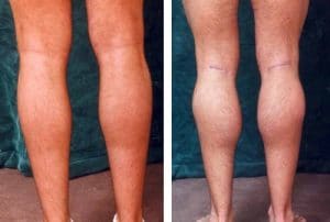 Augmentation mollets Maroc