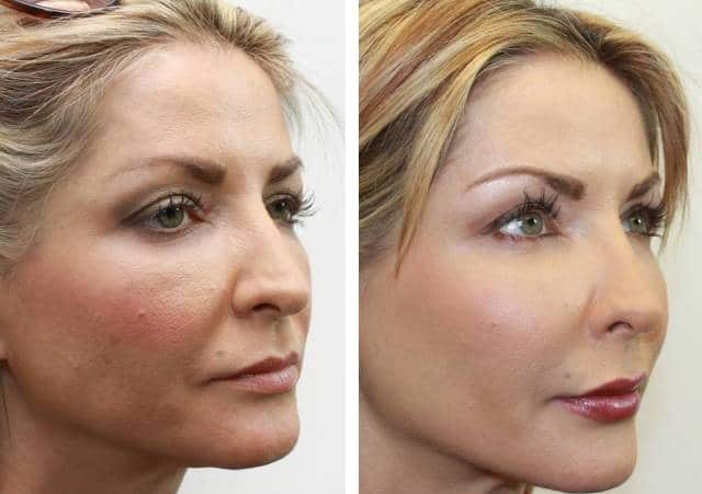 lipofilling visage Tunisie