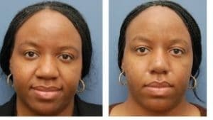 Rhinoplastie ethnique Maroc