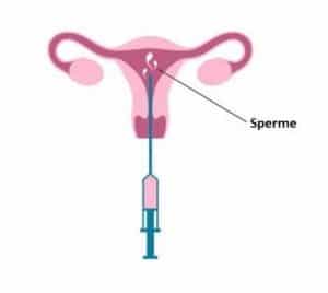 insemination artificielle Tunisie