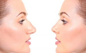 rhinoplastie avant apres