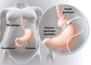 prix anneau gastrique Maroc