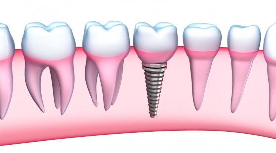 Implant dentaire Maroc