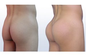 Lipofilling fesses Maroc