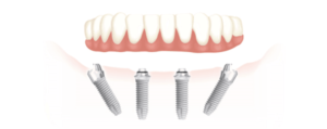 Implants dentaires All-on-4