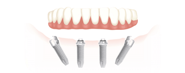 Implants dentaires All-on-4